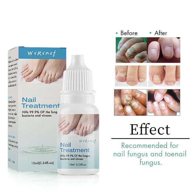 Cremas y lociones para pies, uñas, blanqueamiento de uñas y pies, eliminación de uñas de los pies, esencia para tratamiento de uñas de 10 ml