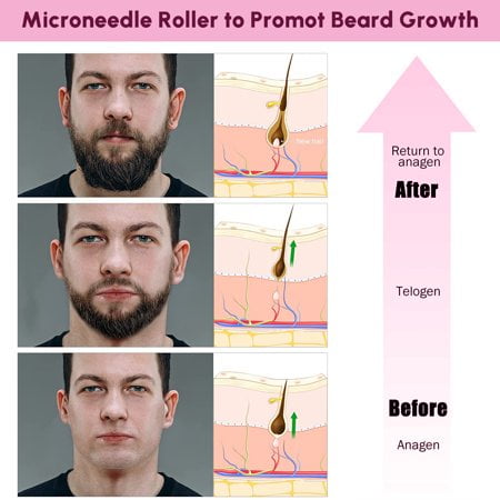 Cosprof 2 Pcs 540 Needles Derma Roller, Microneedle Roller for Face Body Beard Hair Growth, Fast Grow Restoration Strengthen Hair Treatment, Titanium Micro Needles Roller for Home Use, Cosprof 2 Pcs 540 Needles Derma Roller, Microneedle Roller for Face Body Beard Hair Growth, Fast Grow Restoration Strengthen Hair Treatment, Titanium Micro Needles Roller for Home Use,