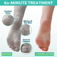 thumbnail image 2 of Mascarilla exfoliante para pies Patchology PoshPeel Pedi Cure, 1 par, 2 of 9