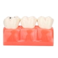 thumbnail image 1 of Oubit Modèle de Dents Caries Simulation, Modèle de Dents Caries Détachable Modèle de Dents Caries Dentaires Modèle Polyvalent, 1 of 9