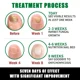 thumbnail image 4 of Hongo fuerte para uñas, cuidado de reparación de uñas, eliminación de hongos para dedos de los pies, antiinfección, nuevo, 4 of 5