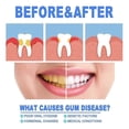 thumbnail image 4 of 1-3pcs Gum Protect Repair Gels 4ml Gentle Teeth Stain Plaque Remover Gum Health Breath Freshener, 4 of 5