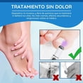 thumbnail image 4 of EELHOE Bolígrafo Luz Azul para Tratamiento de Hongos en Uñas - Elimina Onicomicosis y Paroniquia, 4 of 8