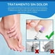 thumbnail image 4 of EELHOE Bolígrafo Luz Azul para Tratamiento de Hongos en Uñas - Elimina Onicomicosis y Paroniquia, 4 of 8