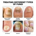 thumbnail image 2 of Láseres para el Tratamiento de Hongos en las Uñas, Limpieza de Dispositivos, Onicomicosis, Reparación Hongos en las Uñas, Eliminación Hongos en las Uñas, Tratamiento Antihongos., 2 of 5