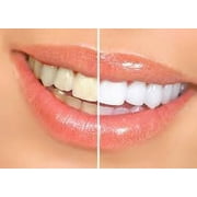 SmartSmiles Professional 3D Teeth Whitening Kit Complete At Home Whitening Kit