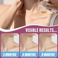 thumbnail image 5 of Vogisg Silicone Scar Gel for Smooth New and Old Scar, Deep Hydration Scar Removal for injury Burn Surgery Acne Stretch Marks 30g/1oz, 5 of 10
