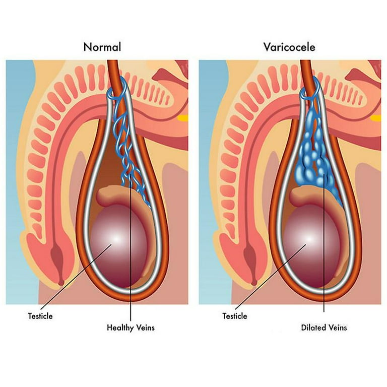 Ungüento para varicocele testicular, 3 uds., crema para venas varicosas para escroto, tratamiento para venas varicosas, ungüento de hierbas sin efectos secundarios A641// kaili Sencillez