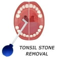 thumbnail image 5 of 1Pc Tonsil Stone Removing Tool Manual Style Cleaner Removal Cleaning Mouth Care, 5 of 7