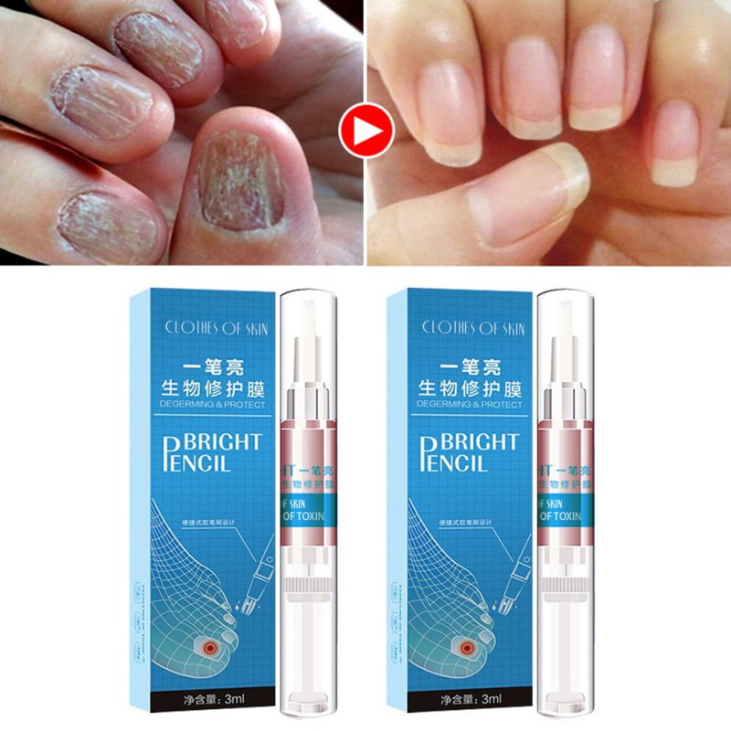 Toenail Fungus Treatment Antibacterial Nail Repair Care Pen Antifungal Treatment