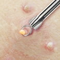 thumbnail image 4 of Removedor de espinillas con aguja, Extractor de espinillas para acné, comedones, imperfecciones, espinillas, herramienta de eliminación de Zit, 4 of 5