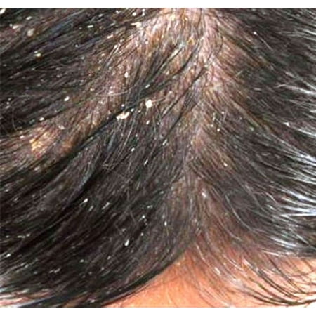 Jamaican Black Castor Oil Hair Food For Dandruff With 2 Pack Satin