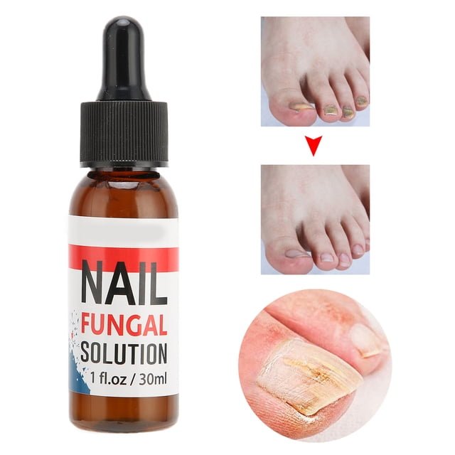 Tratamiento De Hongos En Las Uñas, Tratamiento De Hongos En Las Uñas, Solución De Cuidado De La Salud Para Hongos En Las Uñas De Los Pies Y Pies De Atleta