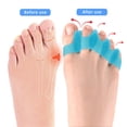 thumbnail image 5 of 2 unidades, separador de dedos, corrector de dedos para corregir juanetes y restaurar la forma original de los dedos de los pies, aliviar el dolor de pies y la fascitis plantar., 5 of 5