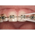 thumbnail image 5 of TEPE Bridge Implant Dental Floss - Thick, Flexible with Stiff Ends for Braces, 5 Pcs, 5 of 5