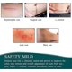 thumbnail image 3 of Silicone Plasters For Scars, Silicone Scar Films For Surgeries, Caesarean Section, Keloids, Burns,silicone Scar Tape-4cm*3m, 3 of 5