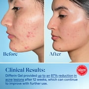 Differin Prescription-Strength Retinoid Acne Treatment Gel for Face with 0.1% Adapalene, Clears & Prevents Acne, Fragrance-Free, 15g Tube