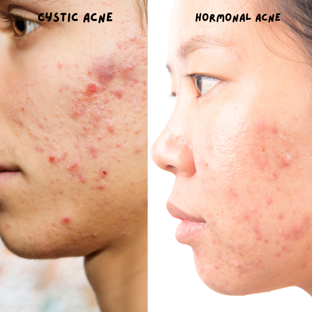 Cystic Chin Acne