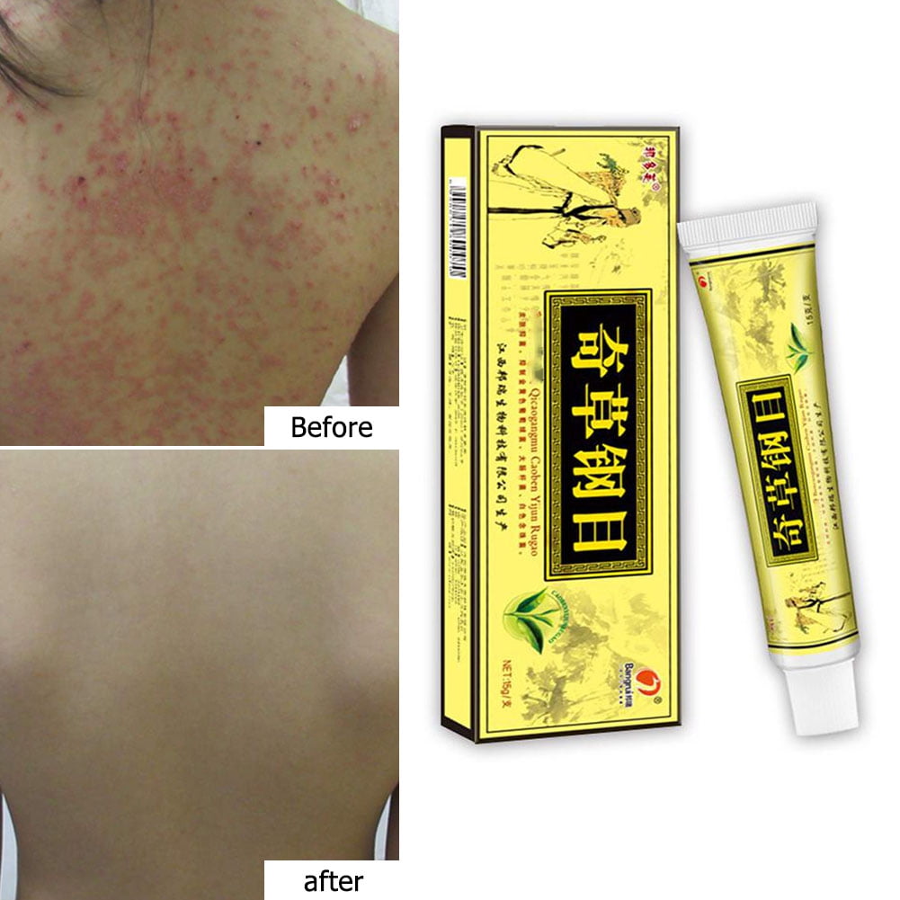RUSR Eczema Ointment Skin Psoriasis Cream Antiitch Cream Treatment for