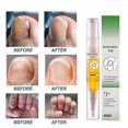 thumbnail image 4 of Nail Fungus Solution Toenail and Fingernail Care Pen Nail Fungal Pen, 4 of 5
