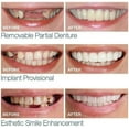 SMILE INSTANT Natural Dental Veneers, 1 Pair Unisex False Teeth Cover