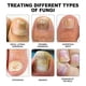 thumbnail image 3 of Dispositivo láser para hongos en las uñas Terapia de luz Tratamiento de onicomicosis en los dedos del pie Inicio -GSL, 3 of 5