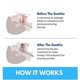 thumbnail image 5 of 2025 New Honex Anti Snoring Mouthpiece, The Quite Night Anti snoring Device, Mouth Guard for Women and Men, Soft and Comforta, 5 of 5