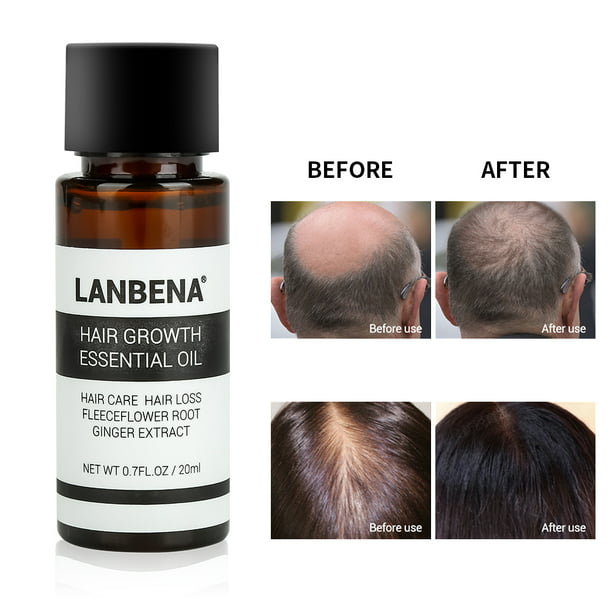 Dilwe LANBENA Natural Hair Growth Essence Oil Ginseng Scalp Health Hair Loss  Treatment Liquid, Essence Oil, Hair Growth Essence 