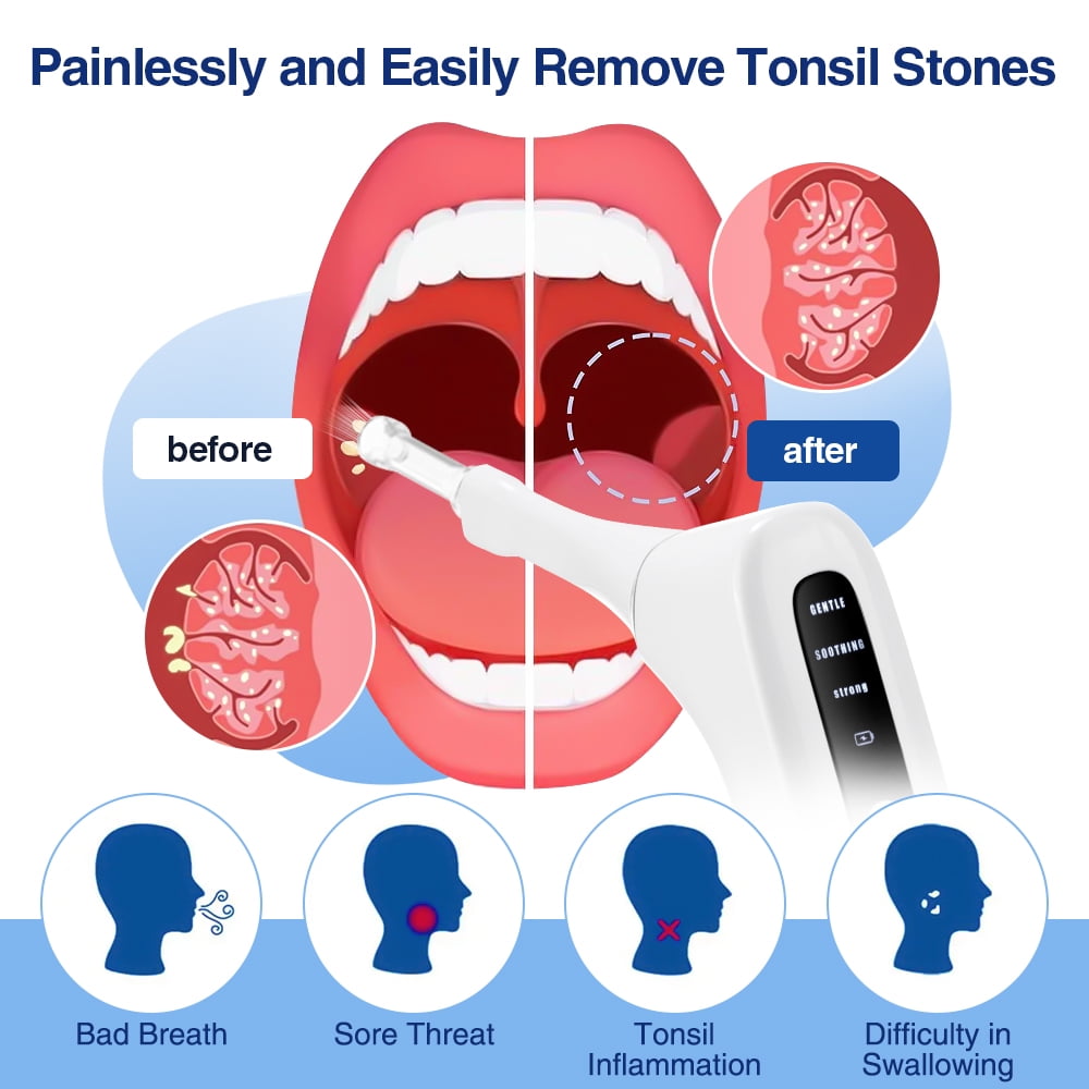 Upgraded Electronic Vacuum Tonsil Stone Remover with Built-in LED Light - Tonsil Stone Removal Kit with 3 Levels Suction,Tonsil Cleaner,Fight Bad Breath Oral Irrigator and 5X Magnifying Mirror,White