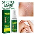 Aisiwm Lightning Deals!Stretch Marks Removal Spray Stretch Marks Belly