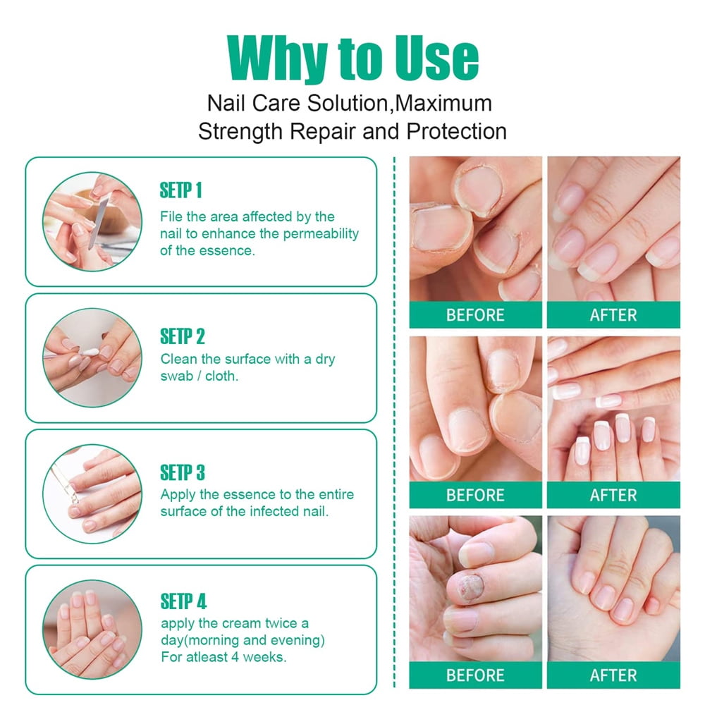 How To Prevent & Treat Skin Peeling Around Nails? – Vedix