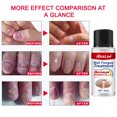 thumbnail image 2 of IBeaLee manufacturer wholesales antibacterial solution for onychomycosis, nail removal paste, thickening soft nail polish, and special solution for onychomycosis, 2 of 5