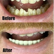 Teeth Instant Smile Bottom Veneers