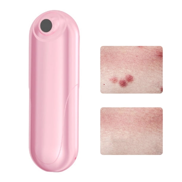 Herramienta para aliviar la picazón de picaduras de insectos recargable por USB, succionador de picaduras de mosquitos sin químicos para picaduras de insectos, abejas y avispas
