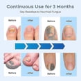 thumbnail image 3 of 2024 Nail Fungus Laser Treatment Device for Multiple Toenail, Home Use 905nm Infrared Light + 470nm Blue Light Toe Nail, 3 of 5