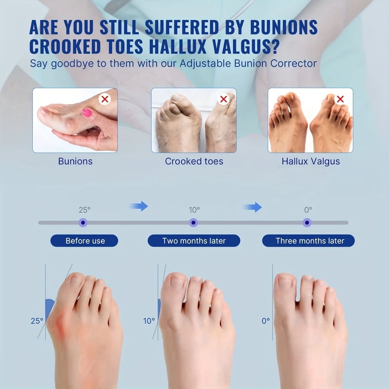 Fit Geno Bunion Corrector Splint - Adjustable Big Toe Straightener For Hallux Valgus, Day & Night Wear For Pain Relief (2 Pcs)