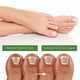 thumbnail image 4 of Nail Care Kit with Roller Beads for Toenail Health Support Unisex 10ML, 4 of 5