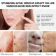 thumbnail image 5 of ZHAOCHENG Suero a base de hierbas para el acné, 17 ml, reparador de la piel contra el acné, tratamiento para el acné, esencia para eliminar las marcas del acné, 5 of 5