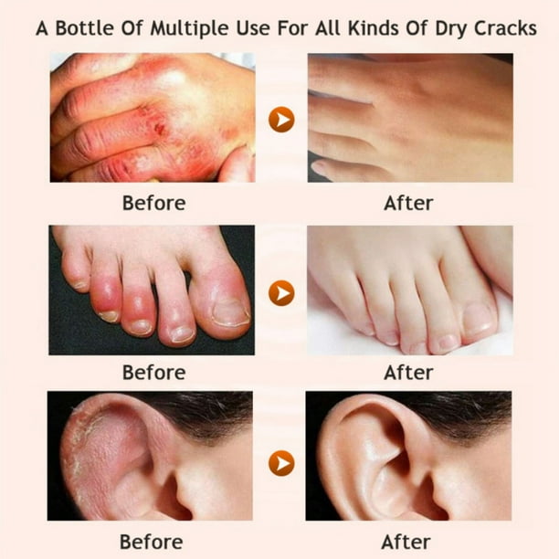 Newway 30g Foot Cream Horse Oil ,Best Callus Remover For Feet, Knees& Elbows,Natural Moisturizes Nourishes Softens Dry, Rough, Cracked, Dead Skin , ...