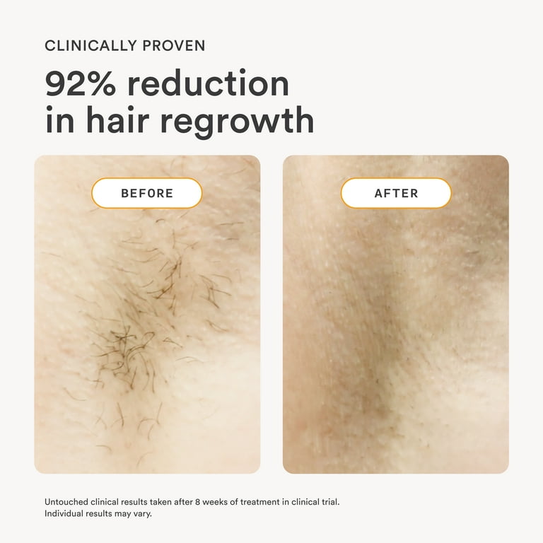 Nood Flasher 2.0 ‚Äî IPL Laser Hair Removal Device for Women & Men