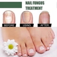 thumbnail image 3 of EELHOE 30ml Nail Fungus Treatment Solution Extracts Remove Onychomycosis No Yellowing Restore Shine, 3 of 5