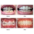 thumbnail image 4 of Mouth Guard,braces Invisible 3 Stages Tooth Appliance Aligners Trays Teeth Straightener Retainer Alignment Trainer Mouth, 4 of 5