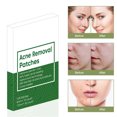 thumbnail image 1 of Parche para espinillas y acné, pegatinas para acné, parches para eliminar espinillas, herramienta de belleza para el cuidado de la piel, 1 of 9