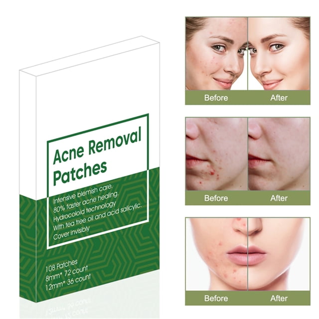 Parche para espinillas y acné, pegatinas para acné, parches para eliminar espinillas, herramienta de belleza para el cuidado de la piel