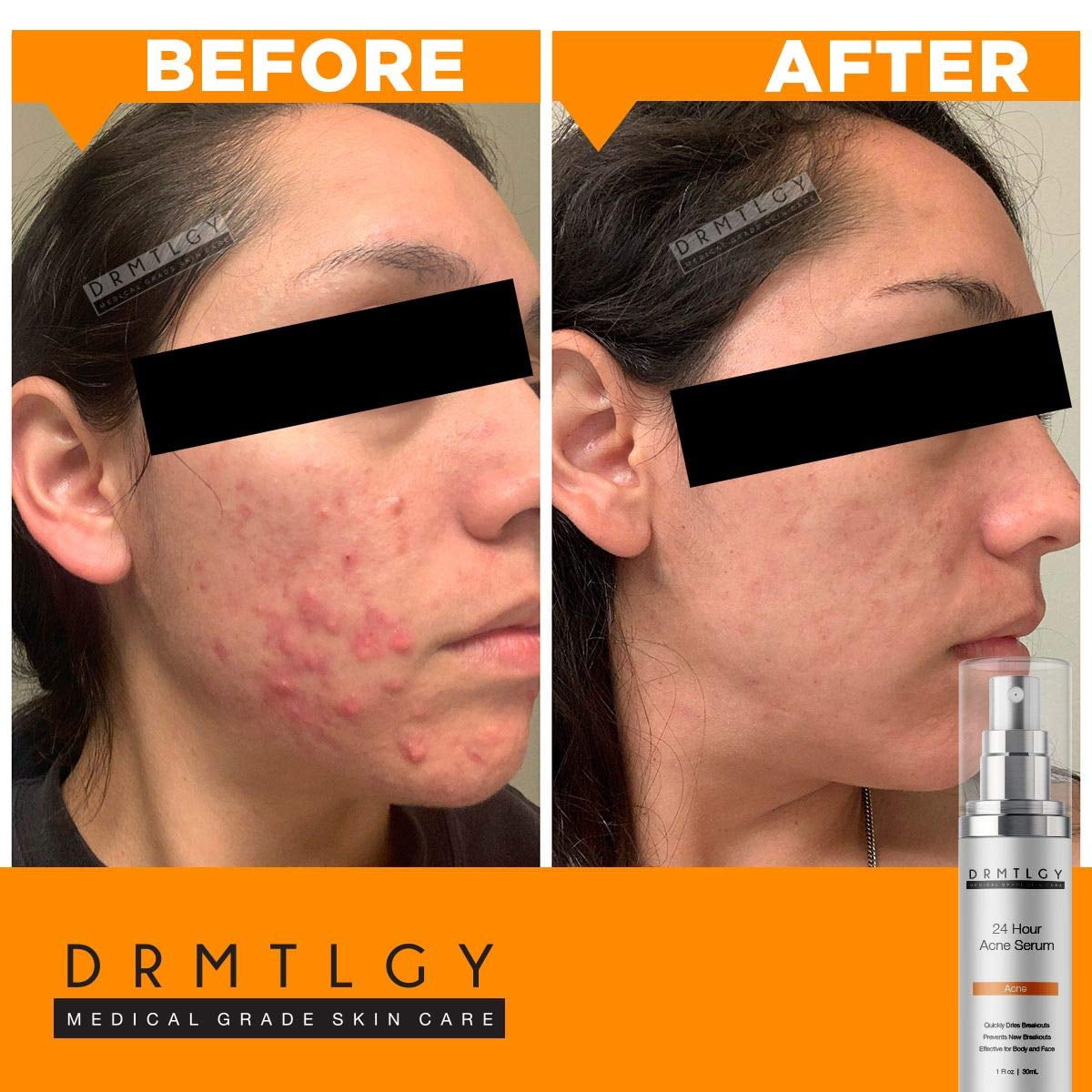 cystic acne serum
