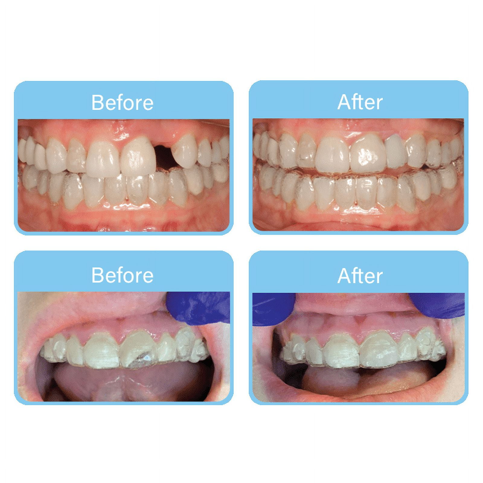 OrVance Aligner Pontics| Specifically Designed to Fill the Space of Missing or (Partially Missing) Teeth in Clear Aligner Trays and Retainer (32 Count)