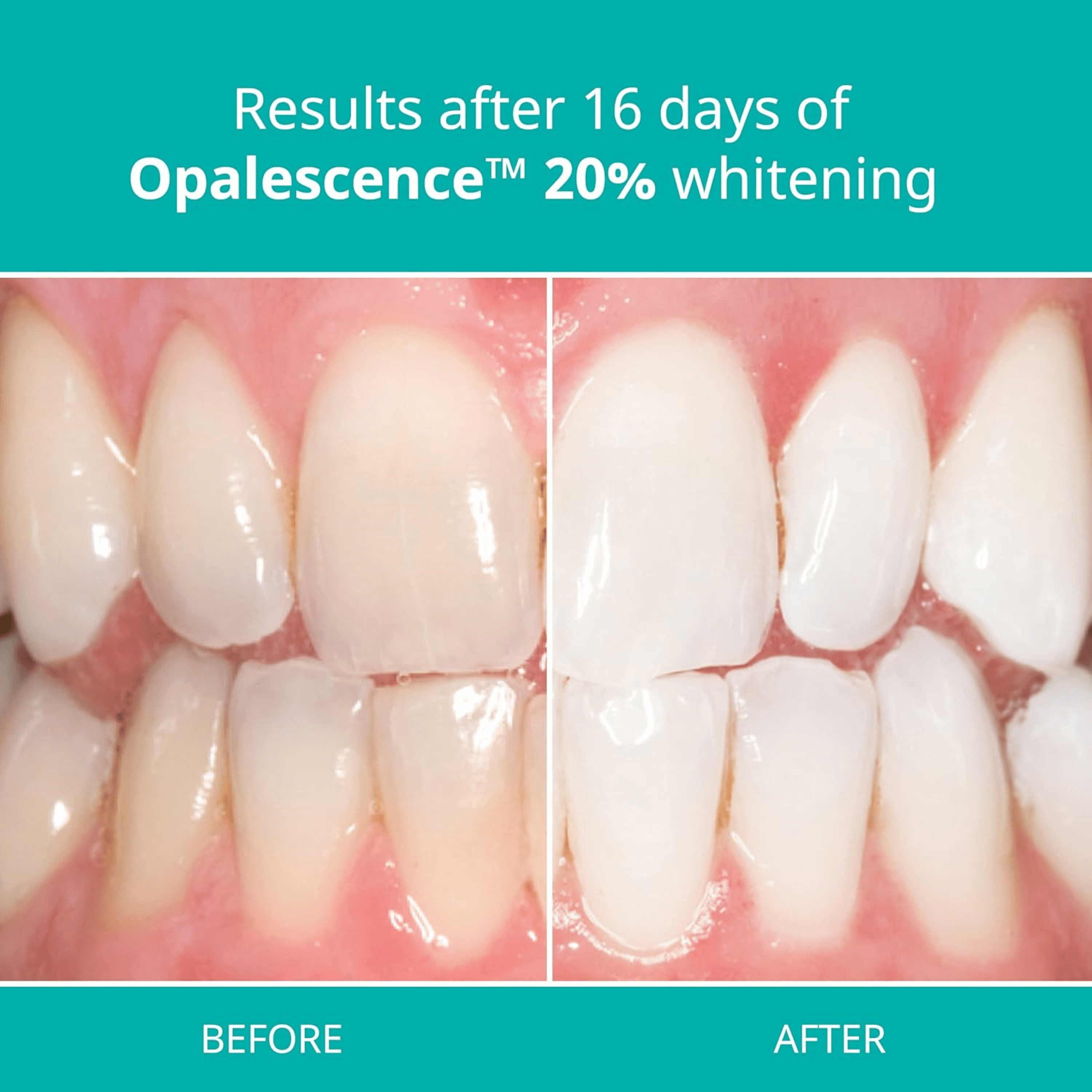 Opalescence 20% Gel Syringes Teeth Whitening Refill Kit (2 Pack / 4 Units) Melon Carbamide Peroxide