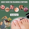 thumbnail image 2 of Extra Strength Nail Repair Fluid - Natural Toenail & Nail Fungus Cure, Discoloration Damage Repair, Anti-Paronychia Solution, 2 of 5