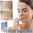 thumbnail image 3 of Crema para eliminar verrugas para el cuidado de la piel, para rostro y cuerpo, eficaz eliminador de verrugas y tratamiento de manchas, 3 of 10