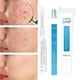 thumbnail image 2 of 1/2/3 Uds Crema para el acné con ácido azelaico elimina acné espinillas blanquea las manchas oscuras cicatrices tratamiento antiacné Gel reduce los poros Control de aceite cuidado facial 10g, 2 of 4